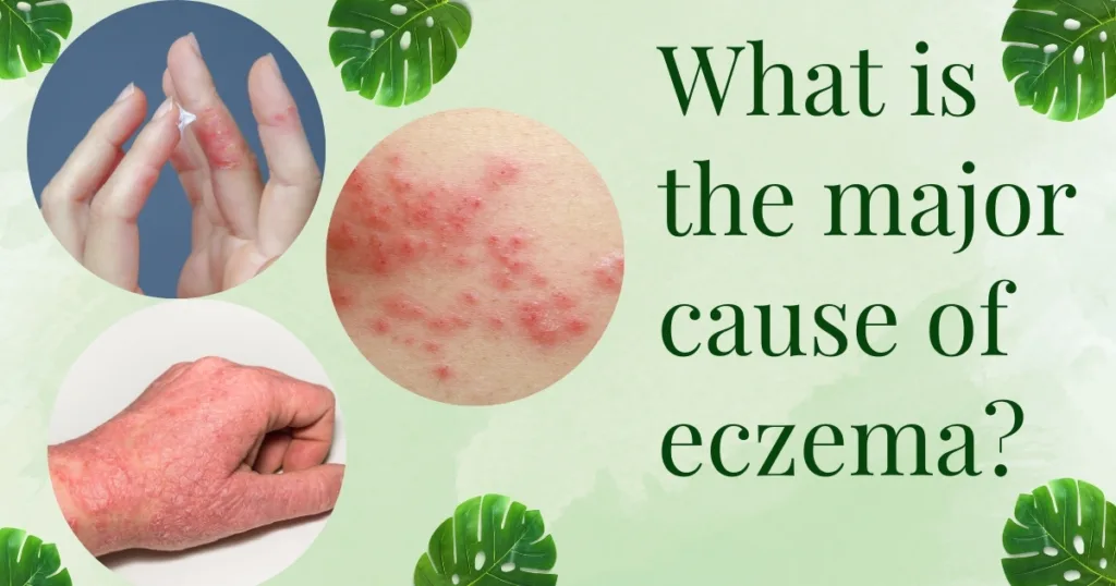 causes of eczema
