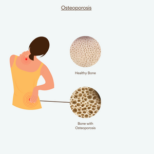 Osteoporosis solutions