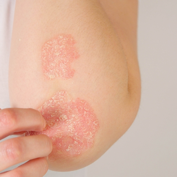 Psoriasis