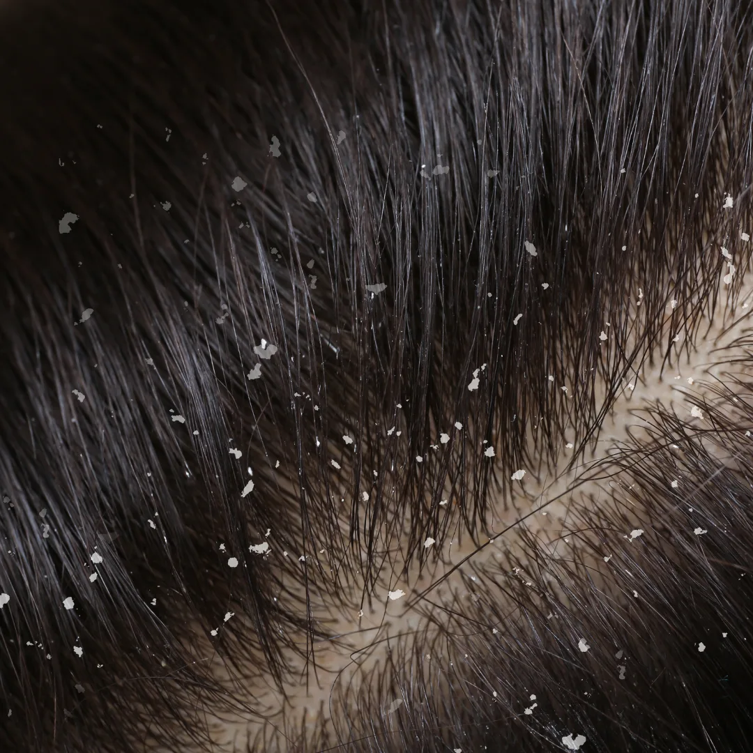 Dandruff control